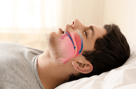 Man sleeping with airway animation on profile