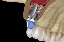 Diagram of an integrated dental implant in Buckhead