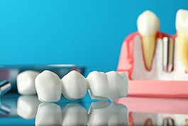 Dental bridge in front of model dental implant on reflective surface