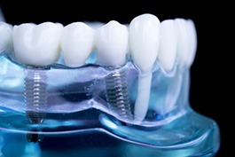 Sample implant bridge in clear model jaw with black background