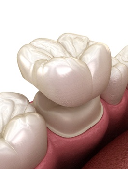 Diagram of dental crowns in Buckhead