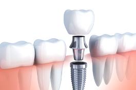 dental implant with abutment and crown in the lower jaw