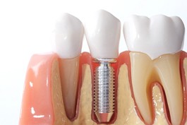 dental implant post in a model of the jaw