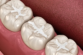 Digital image of tooth-colored fillings