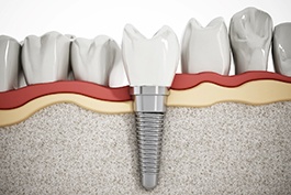 3D illustration of a dental implant, abutment, and crown 