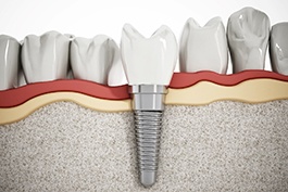 3D illustration of a dental implant, abutment, and crown