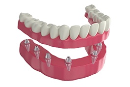 Illustration of fixed implant dentures with white background