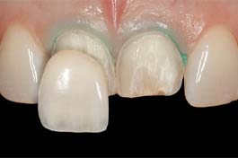 a row of teeth with dental veneers covering all but one tooth