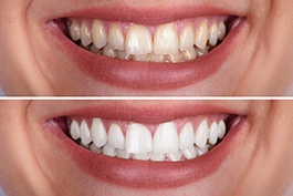 Before and after teeth whitening treatment