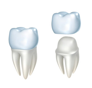 Model of a crown being put on a tooth 